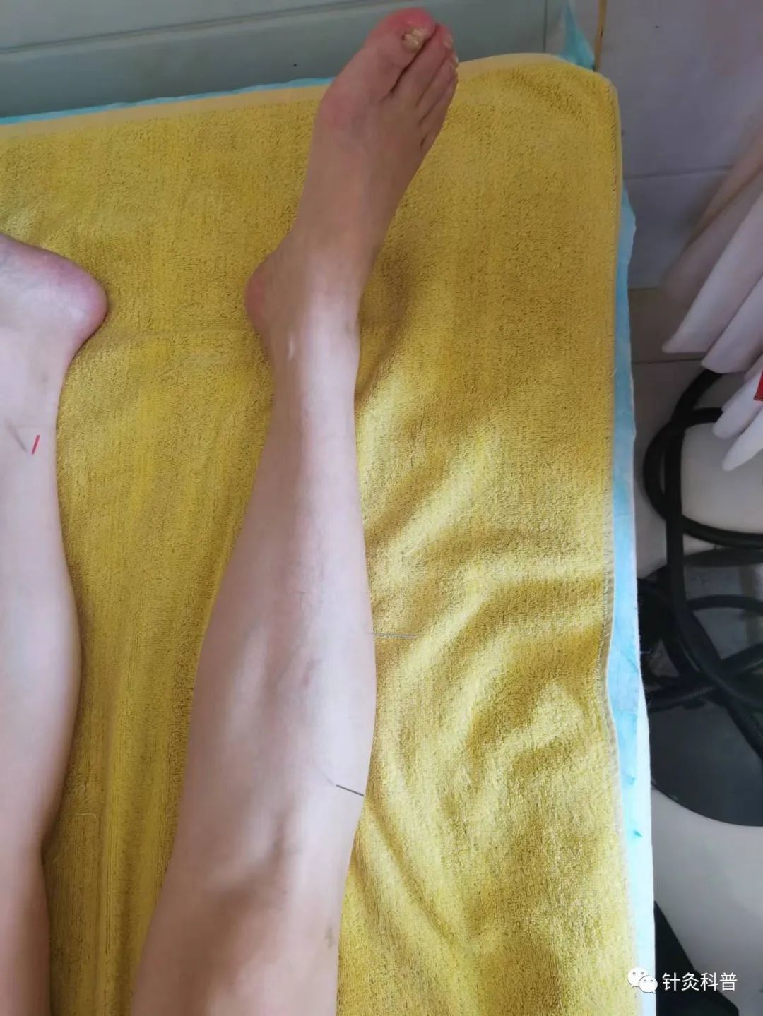 董氏针灸治肾病综合征处方,肾病综合征针灸