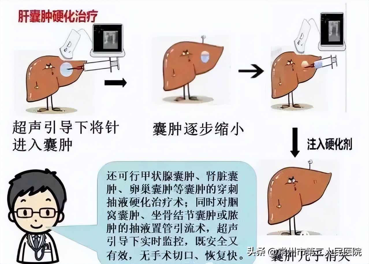 小针孔，用途多，漫画带你了解介入超声能做啥？