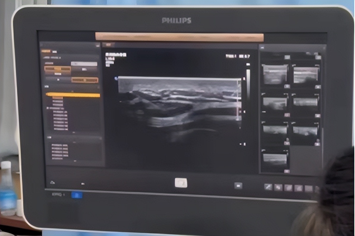 肩周炎疼痛位置注射疗法,肩周炎后伸受限针刀治疗