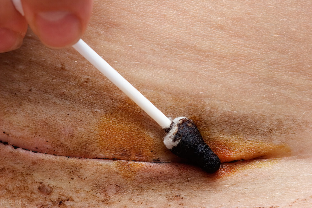 引起产褥感染的病因是,产褥感染预防宣传图片