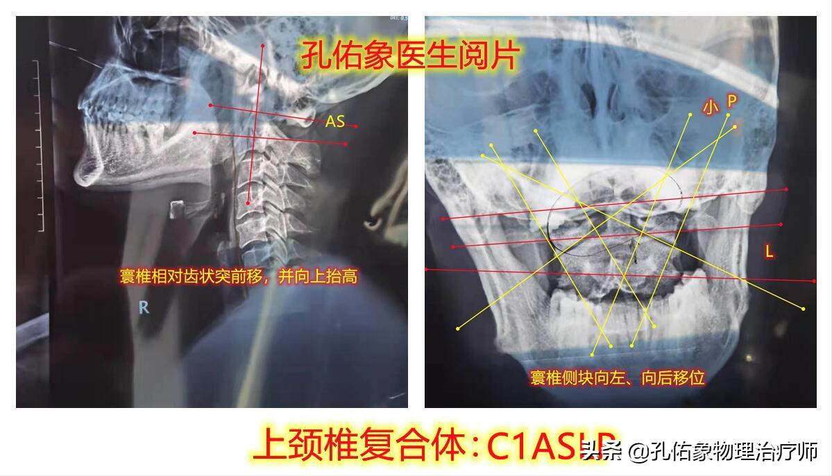 左肩胛骨有时胀痛麻是咋回事,更年期左侧肩胛骨疼是什么原因