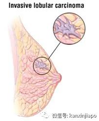 浸润性乳腺导管癌一期能治疗好吗,浸润性导管癌和小叶癌预后哪个好