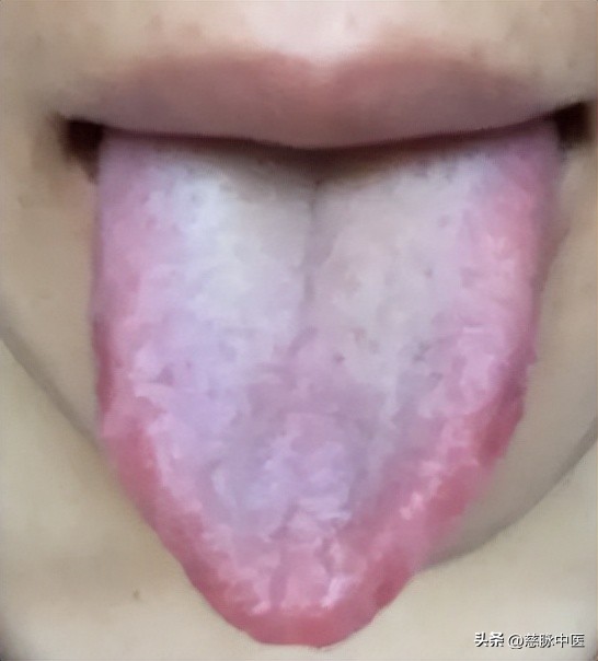 有什么方法不吃药感冒就会好,在家治阳了没有药怎么治