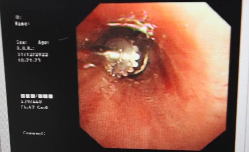异物掉到支气管肺里怎么办,异物从气管掉入肺里咋办
