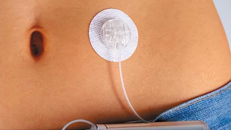 science子刊投稿,糖尿病胰岛移植最新进展