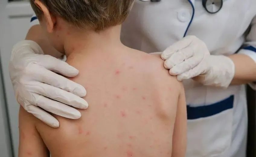 一到晚上就荨麻疹风团是什么原因,皮肤瘙痒荨麻疹的原因及治疗方法