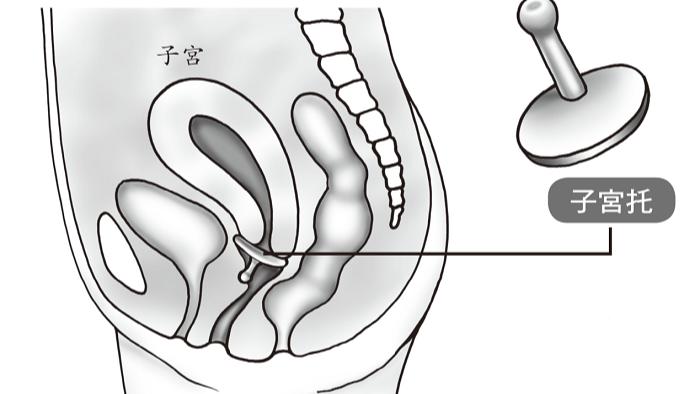 女性六十岁子宫脱垂怎么治疗,子宫脱垂一级的女性多吗