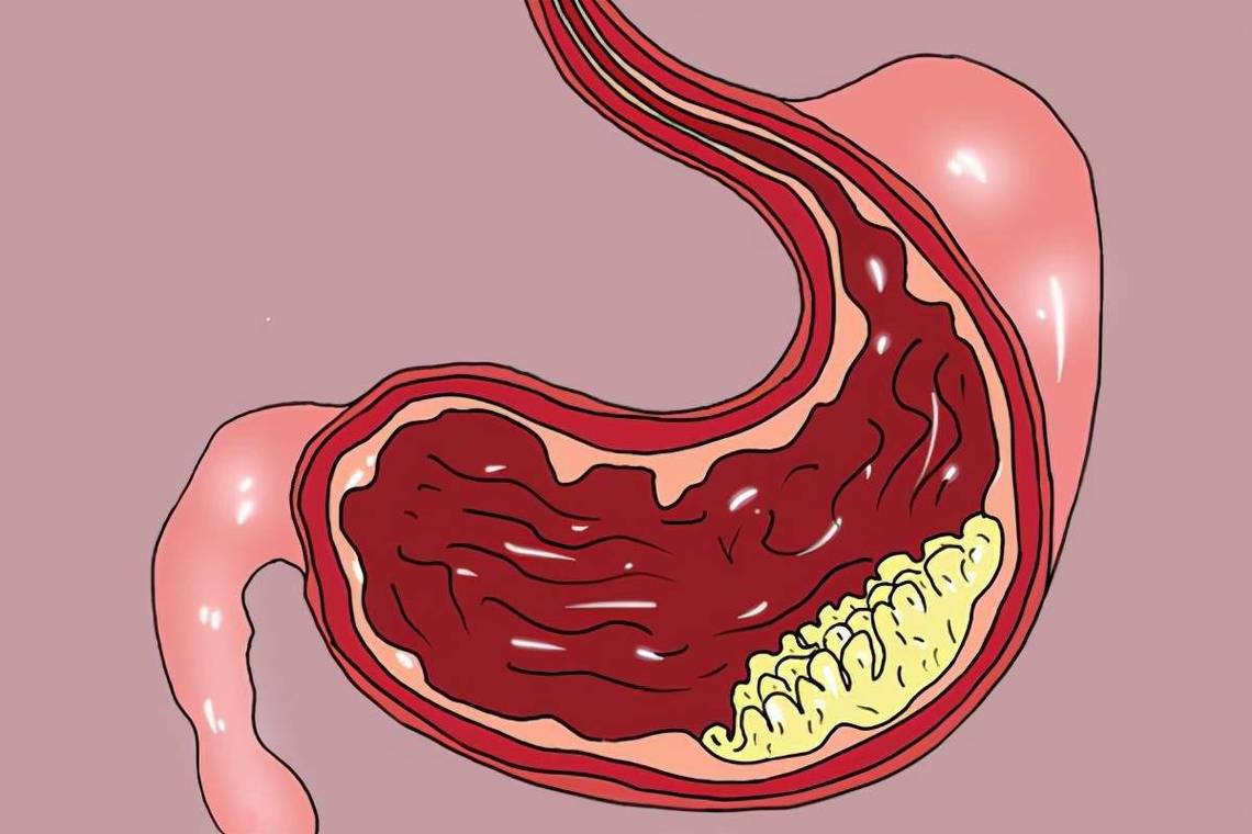 中医针灸糖尿病2型能治好吗,针灸可以治胃轻瘫