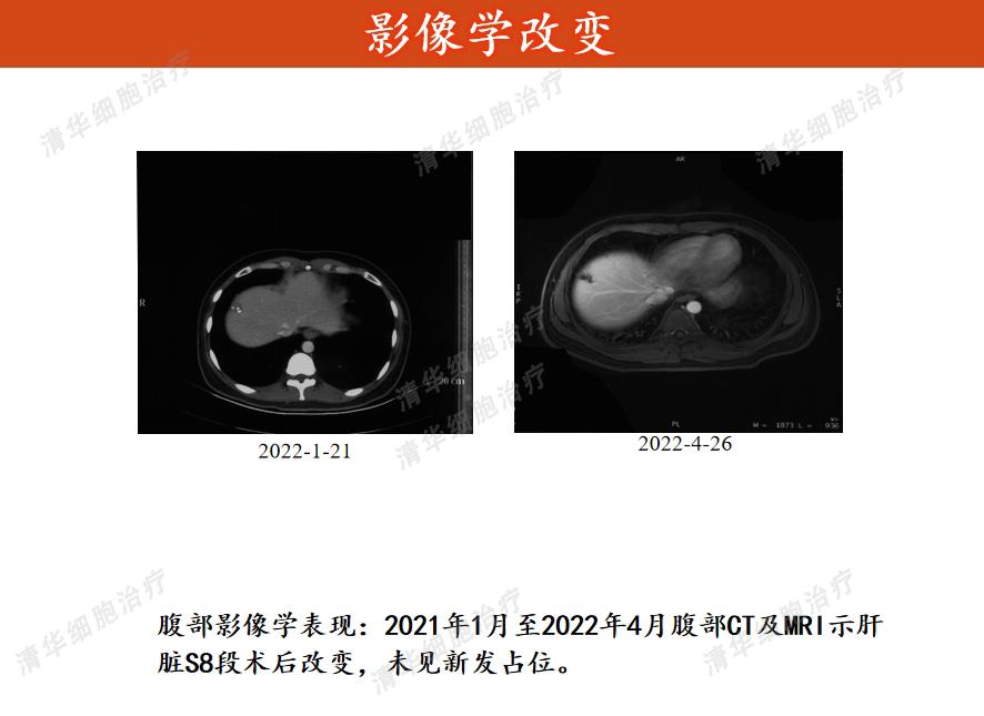 确诊肠癌了该怎么办,确诊癌症先别绝望