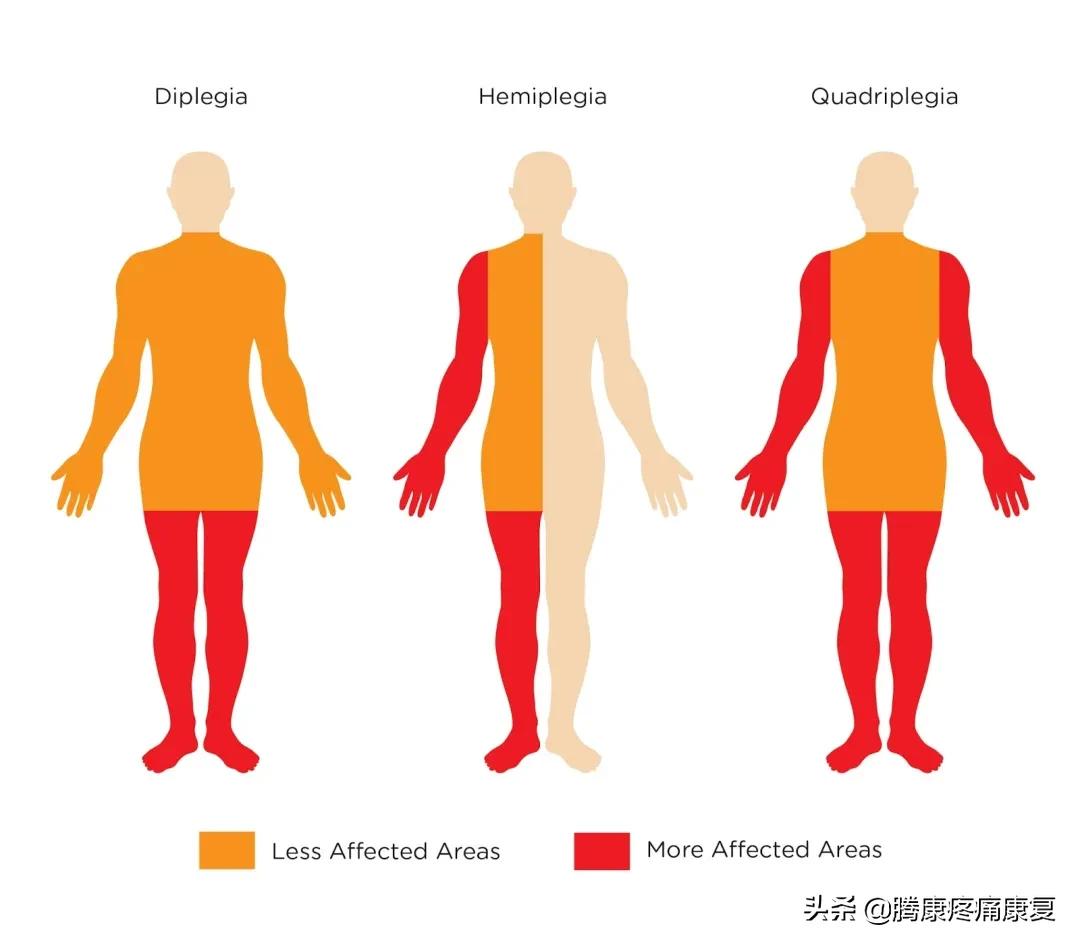 中风偏瘫康复锻炼腿酸困咋回事,中风导致的偏瘫的自我康复锻炼