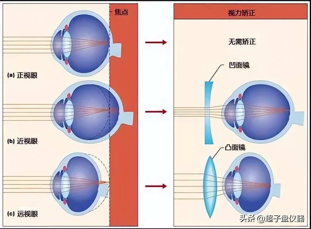 近视手术和白内障手术原理一样吗,激光治近视的原理是什么