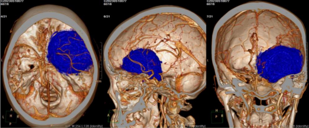 脑肿瘤单眼视力下降,老年人视力下降眼下有黄斑
