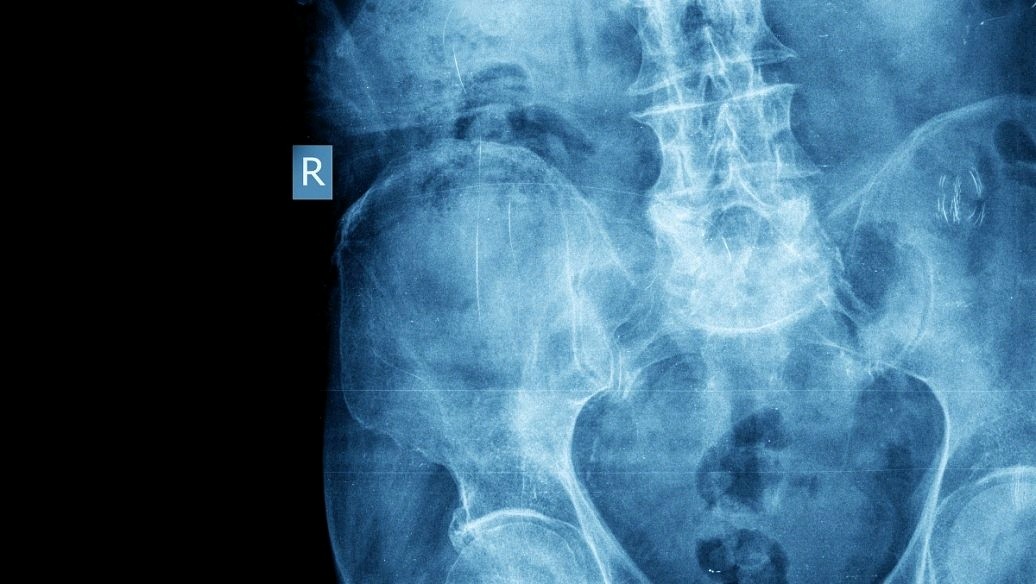 冠脉造影对身体有多大影响,做了冠脉造影对周围有辐射吗