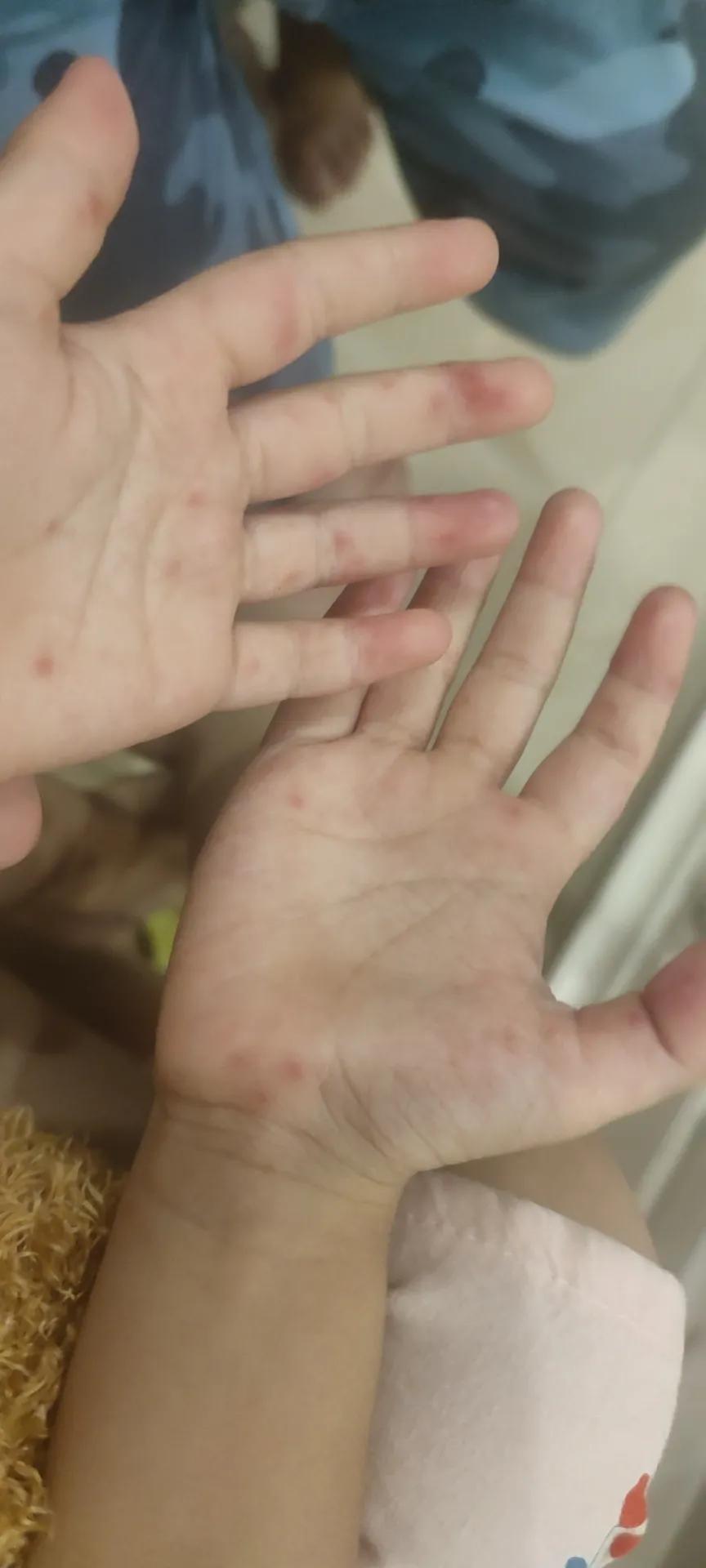 手足口复学证明怎么写,手足口认知总结