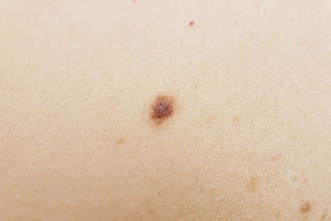 痣长得多好吗,痣比较多正常吗