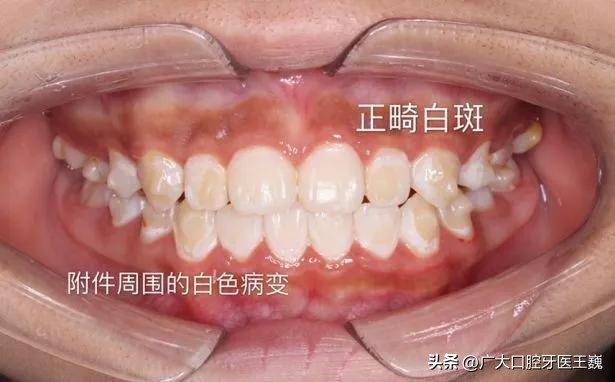 隐形牙套上面有白点,牙套上的白点是什么