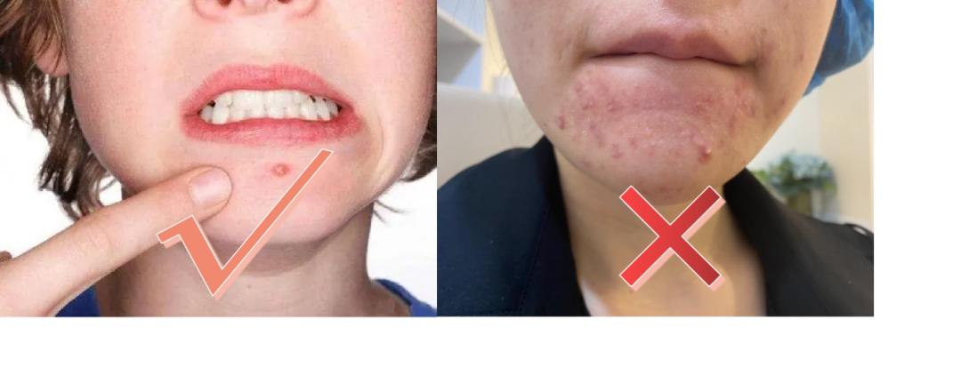 痘痘贴有用吗真实测评,痘痘贴真的祛痘吗