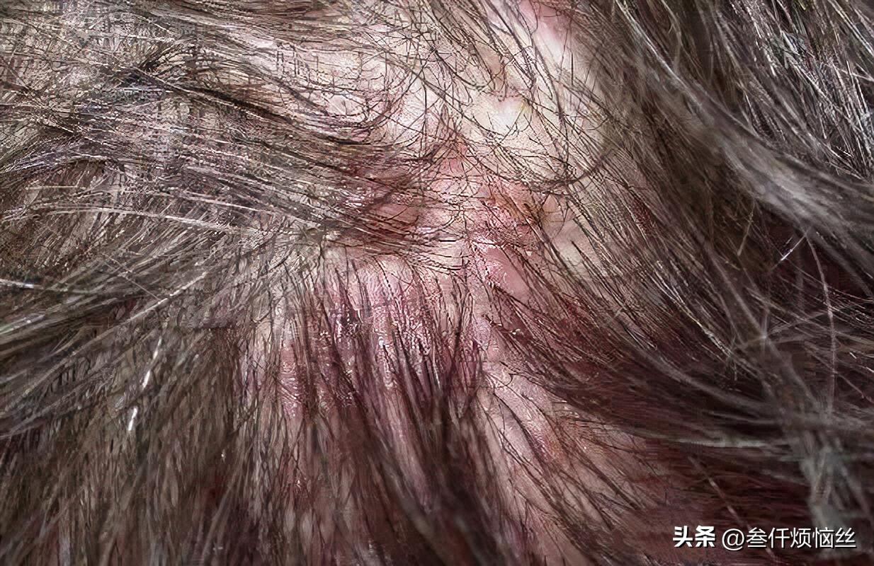 头发过敏用什么染发剂,染发剂过敏的一个现象