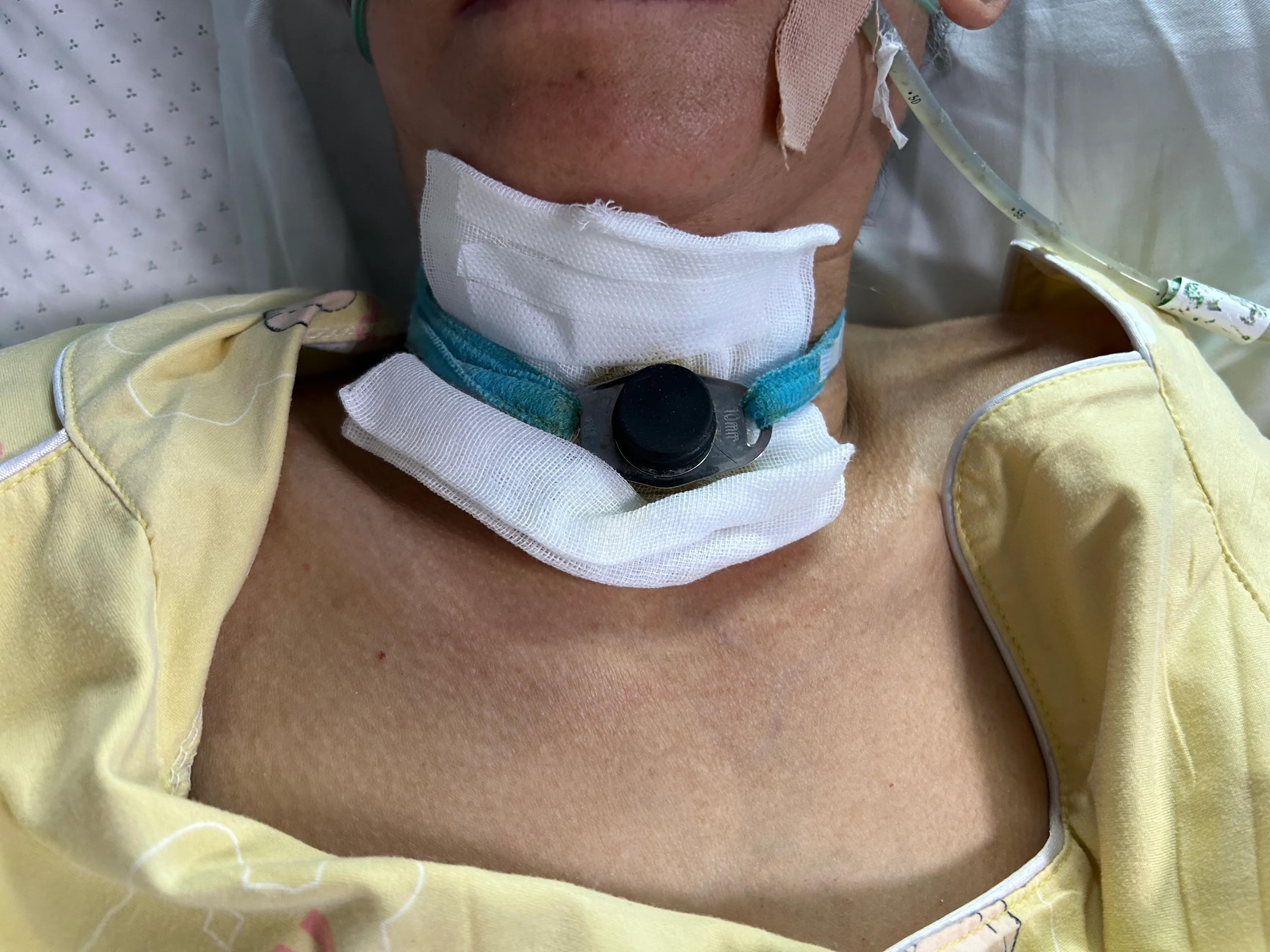 气管套管什么条件下可以拔除,怎么拔出气管套管