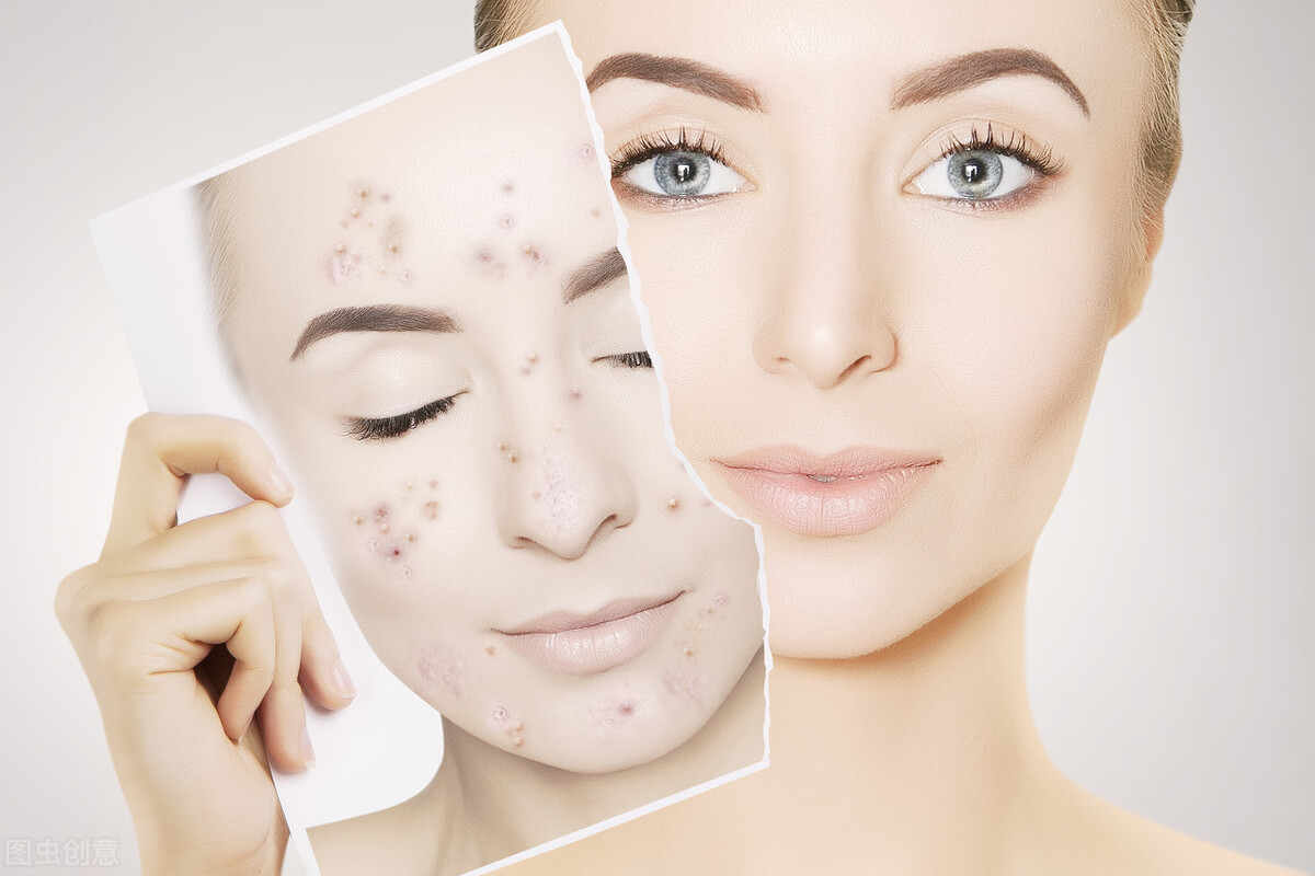痘痘肌肤是祛痘还是修复屏障,痘痘肌肤全解析让你祛痘不再迷路