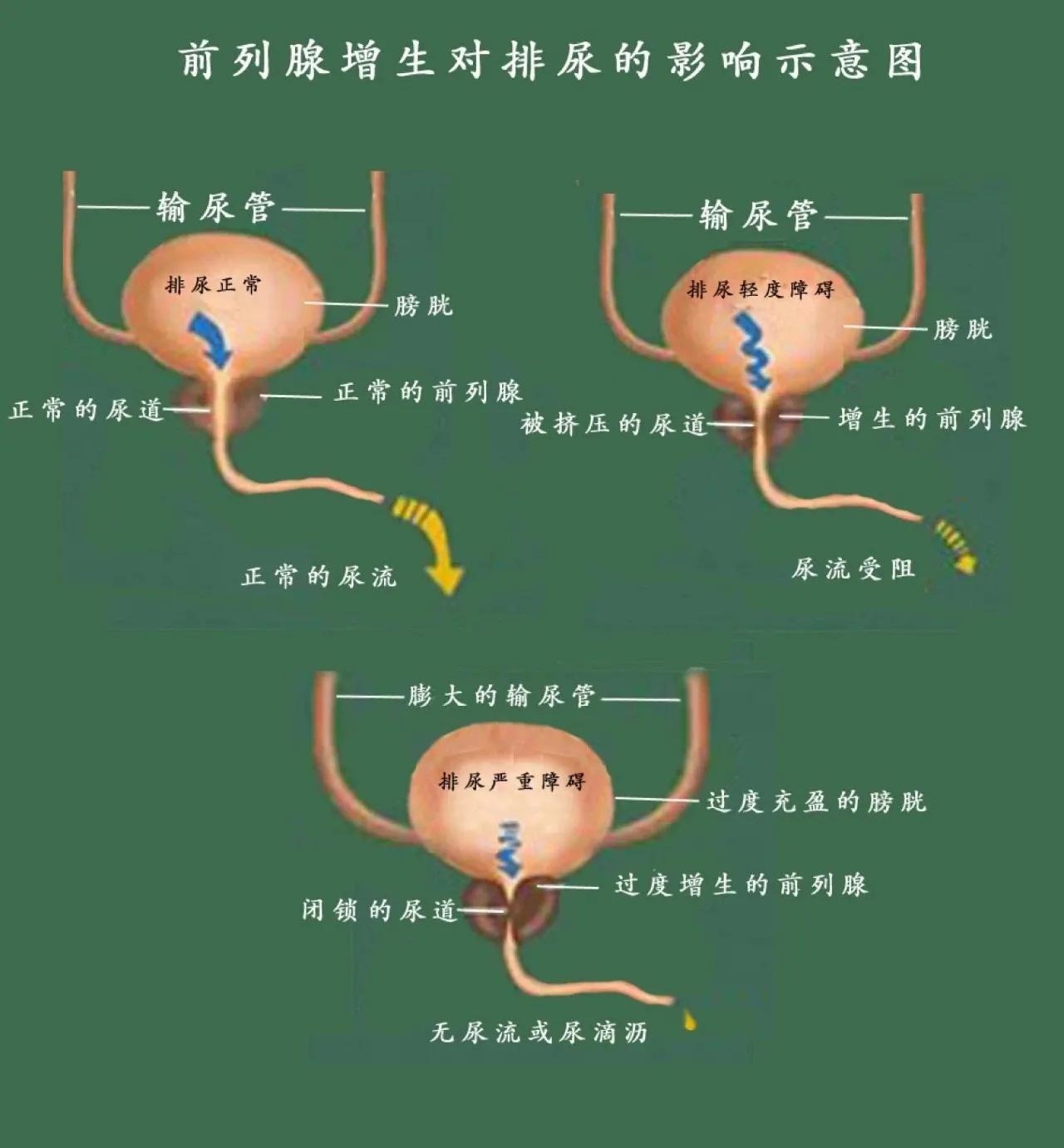 男性前列腺的常见问题,男性应警惕前列腺炎两个误区