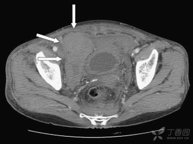 女性右腹部隐痛轻微出血,女性突发性腹部剧痛