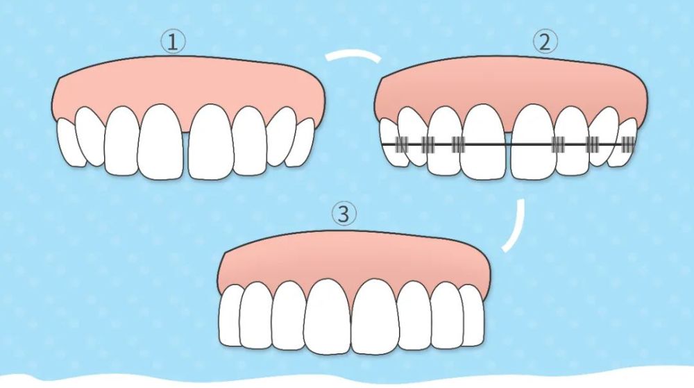 树脂补牙缝和贴面哪个好,牙缝大正畸还是贴面