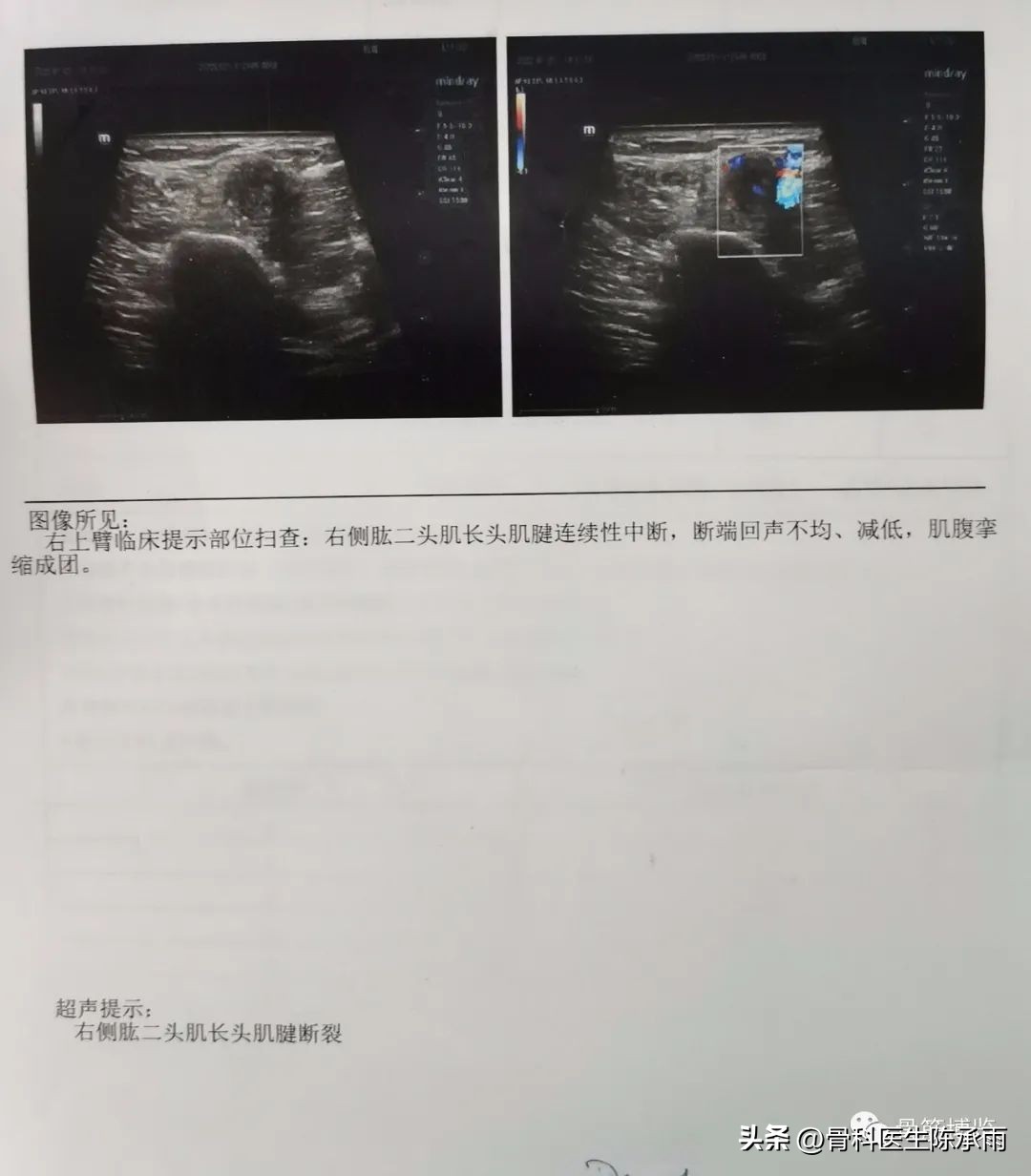 肱二头肌长头肌腱断裂超声报告,上臂肱二头肌