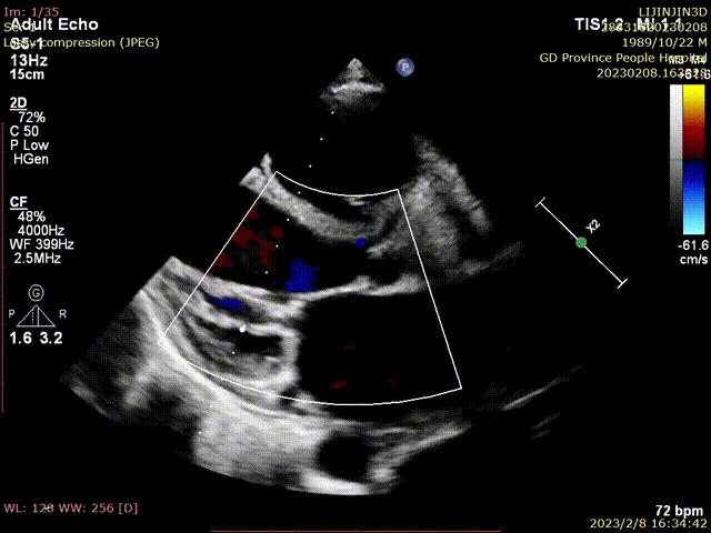 二尖瓣狭窄病例分享,二尖瓣病理生理及治疗方法