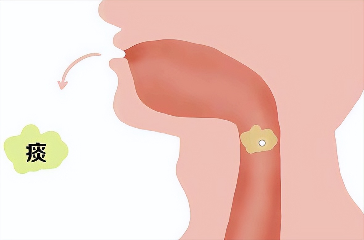 痰在哪儿,痰都在哪