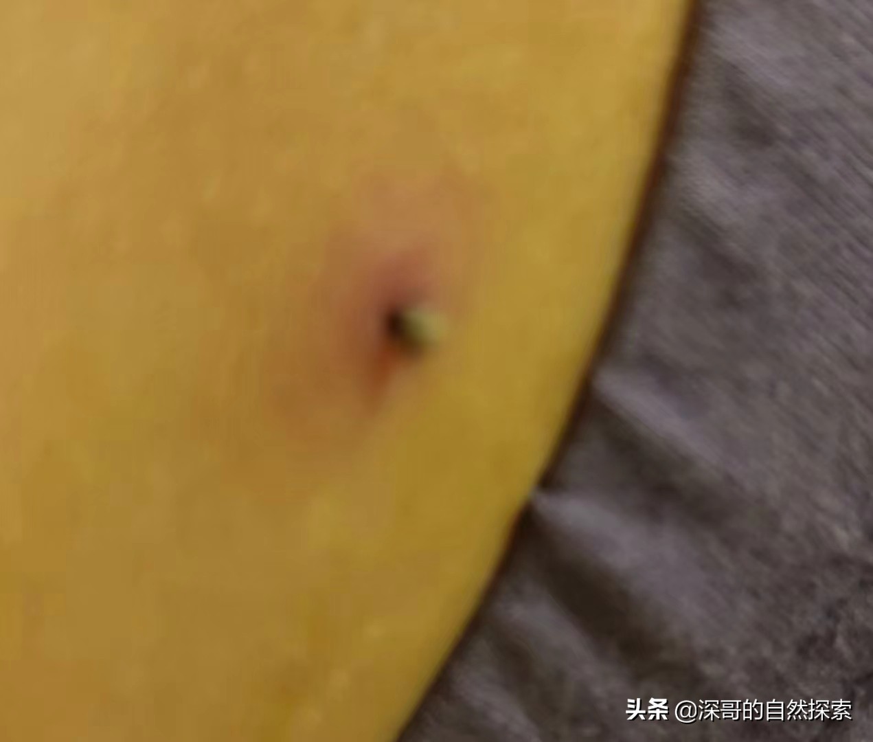 关于我在深圳爬山，被蜱虫咬这件事