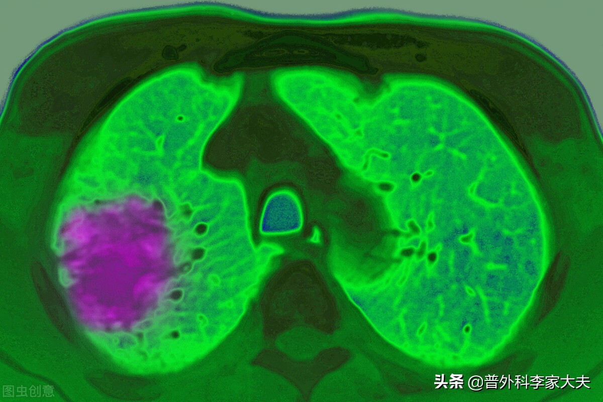 肺癌晚期转移淋巴结能完全治愈吗,从一期肺癌到二期肺癌发展时间