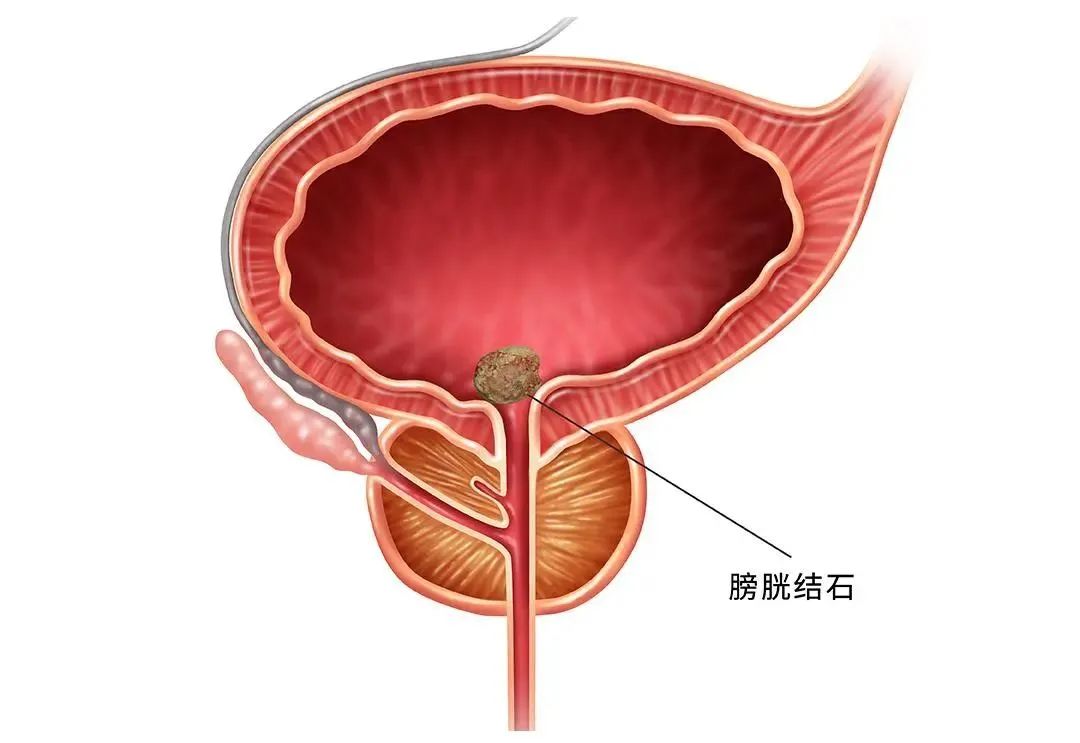 排尿困难尿不出来是怎么治疗,有尿感但排尿困难还排不尽