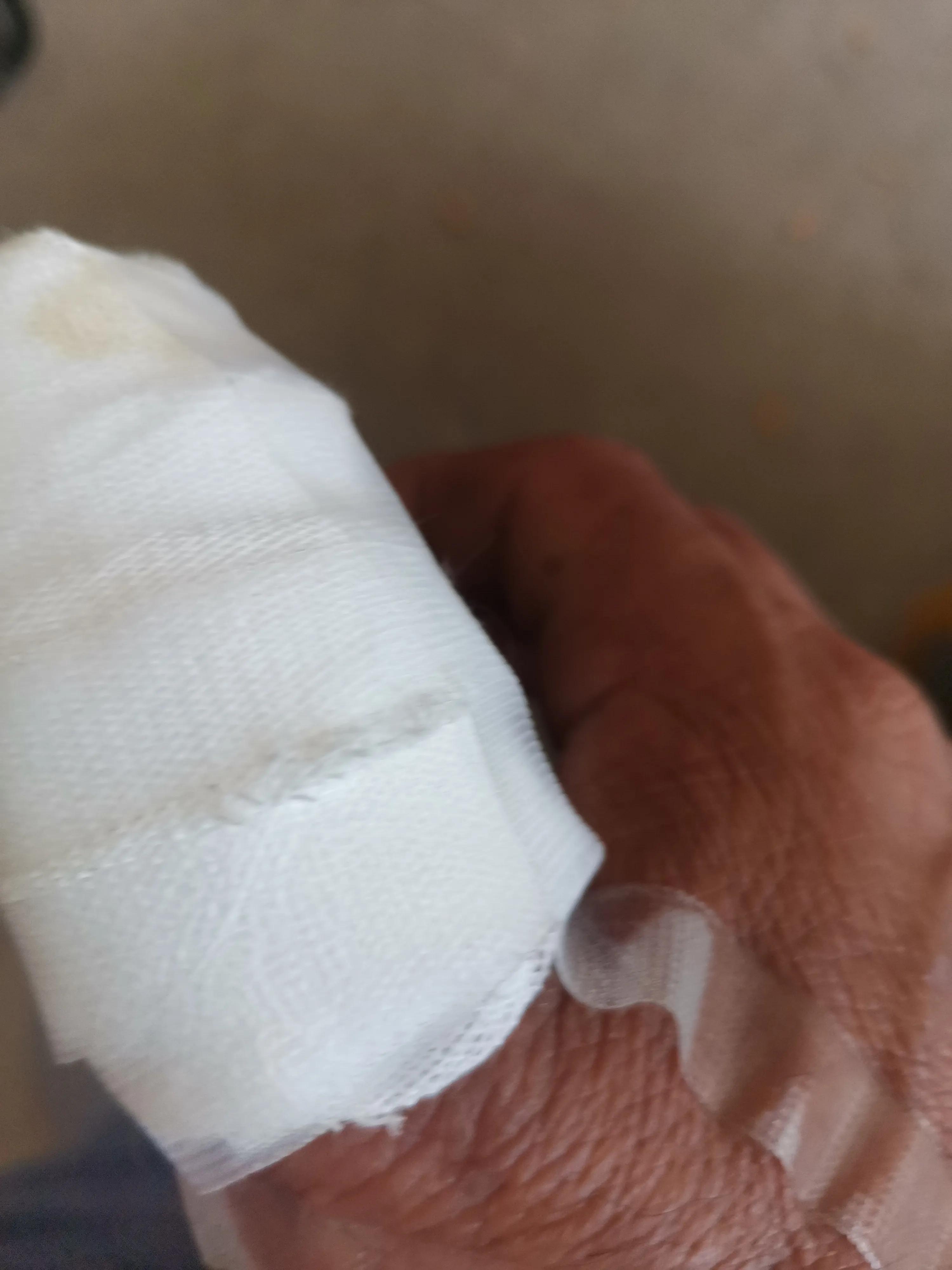 怎么预防手指化脓,大拇指预防甲沟炎的最佳方法