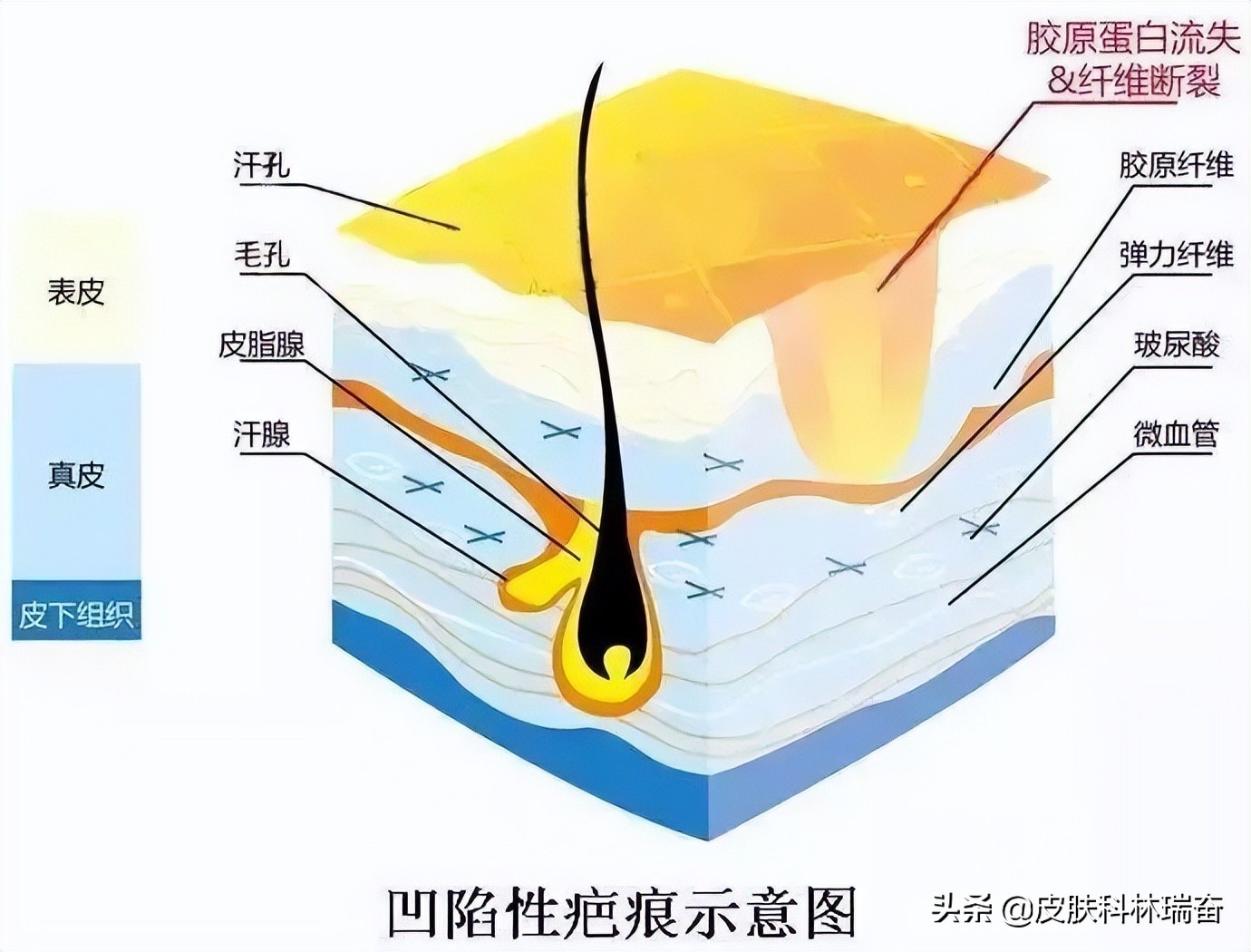 激光凹陷性疤痕修复多久可以恢复,让凹陷性疤痕长平的家庭小妙招