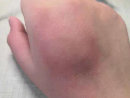 夏天时节，农村的“毛毛虫”真惹不起，被蜇后解药就在它身上