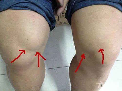 身体上长了脂肪瘤怎么办？需要处理吗？