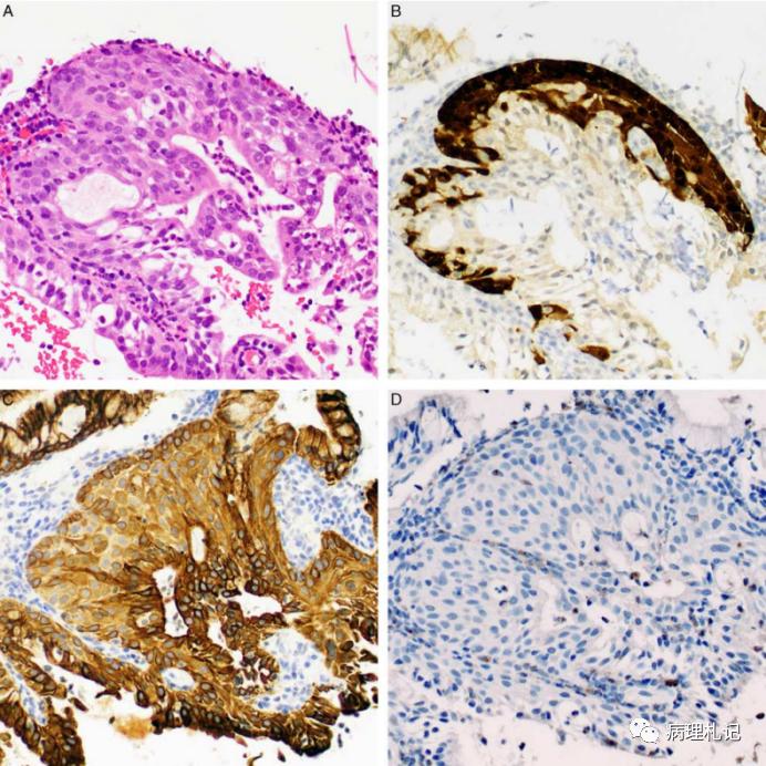 宫颈病理免疫组化p16是什么意思,p16阳性低度上皮病变严重吗