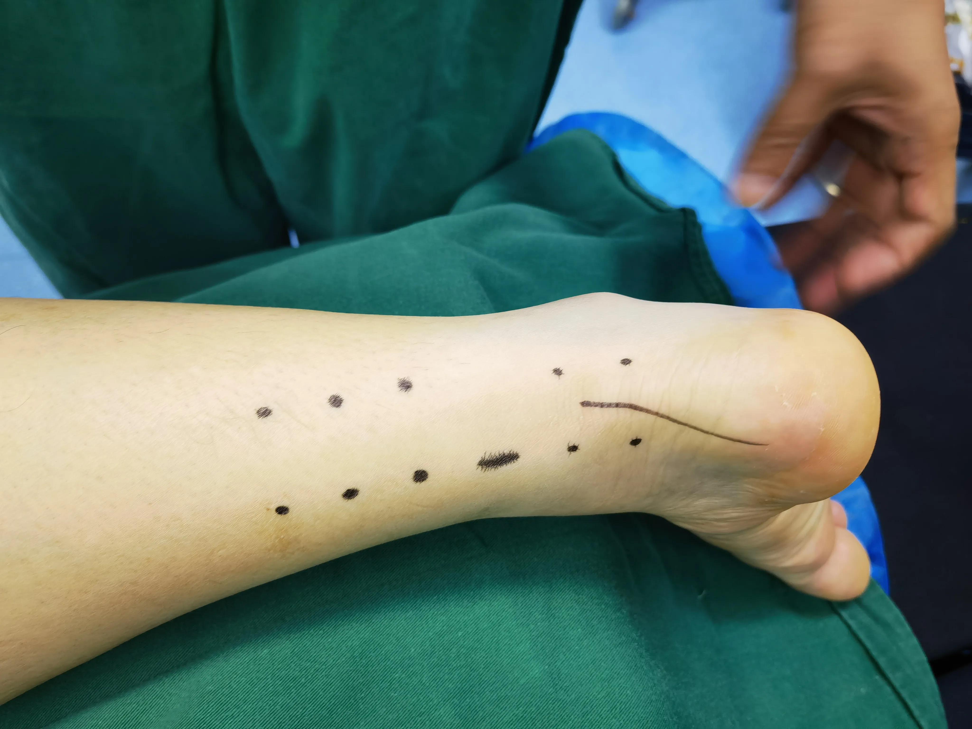 跟腱断裂的微创治疗,跟腱断裂微创手术修复演示图