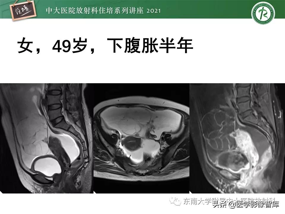 卵巢浆液性肿瘤的肉眼及镜下特征,卵巢原发性粘液性囊腺瘤