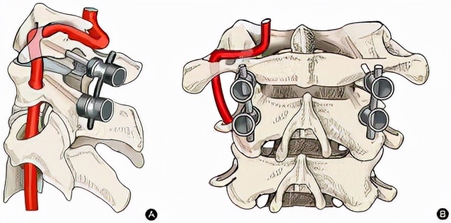 儿童落枕最快恢复办法,落枕了30秒自愈方法儿童
