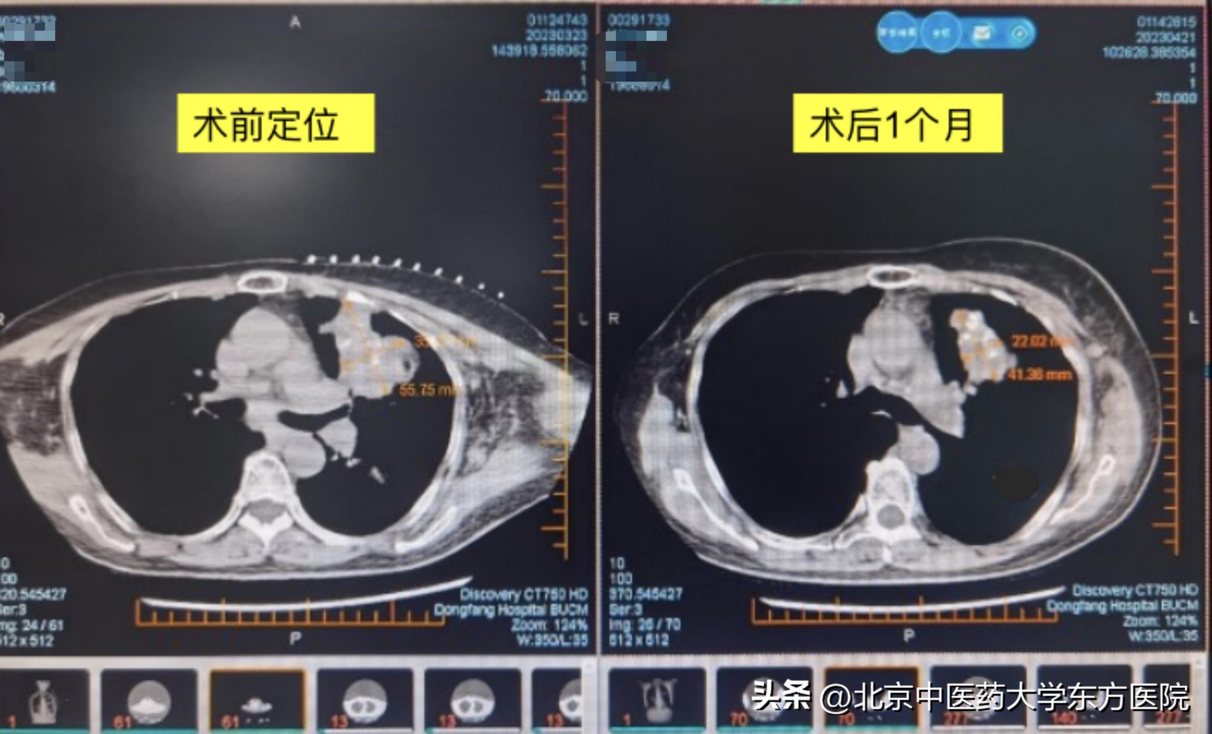 北京中医药大学东方医院疾病科,北京医院肿瘤内科新技术治疗癌症