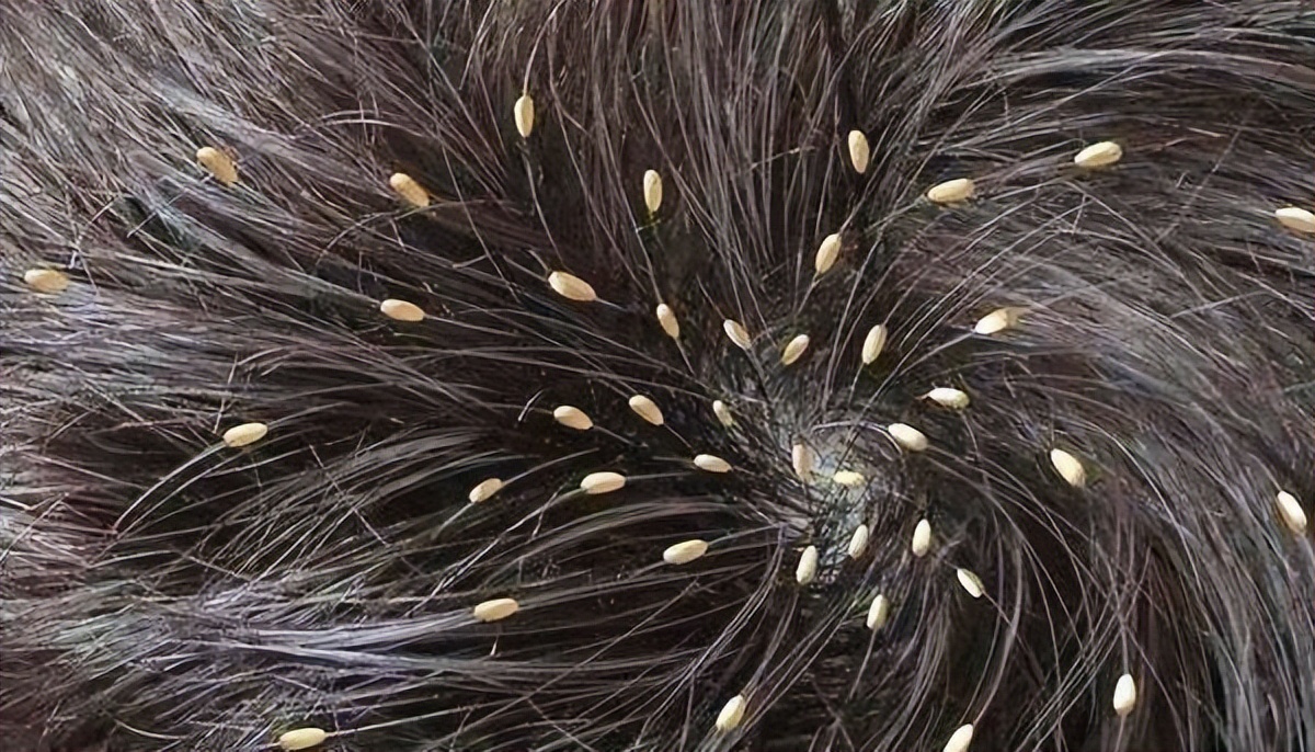 和人类共同进化的虱子，30多年前很常见，现在怎么看不到了？