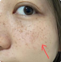 褐青色斑中医怎么治疗,中药调理能淡黄褐斑吗