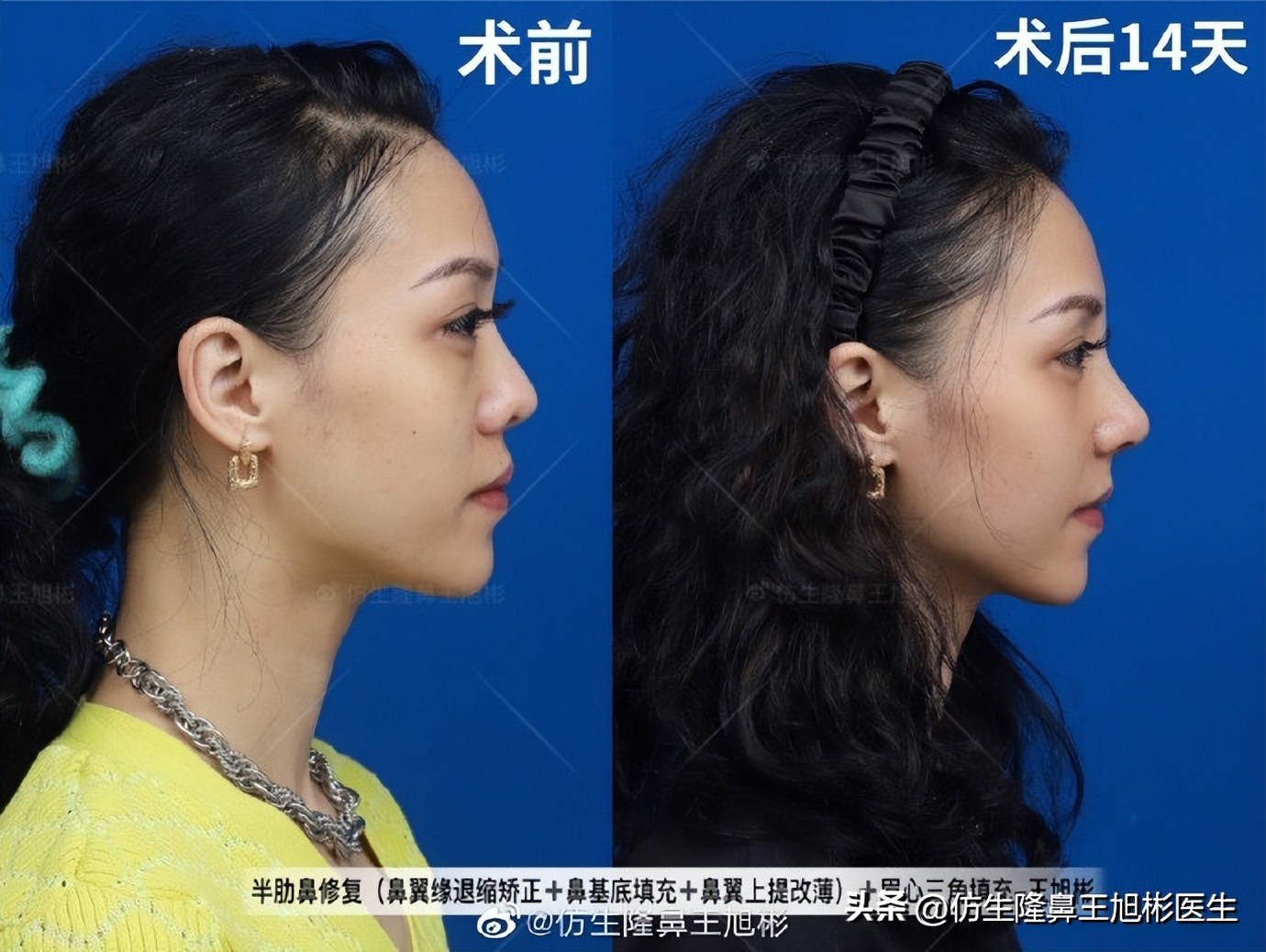 鼻基底填充会移位到鼻孔吗,鼻基底填充假体会拉长人中吗