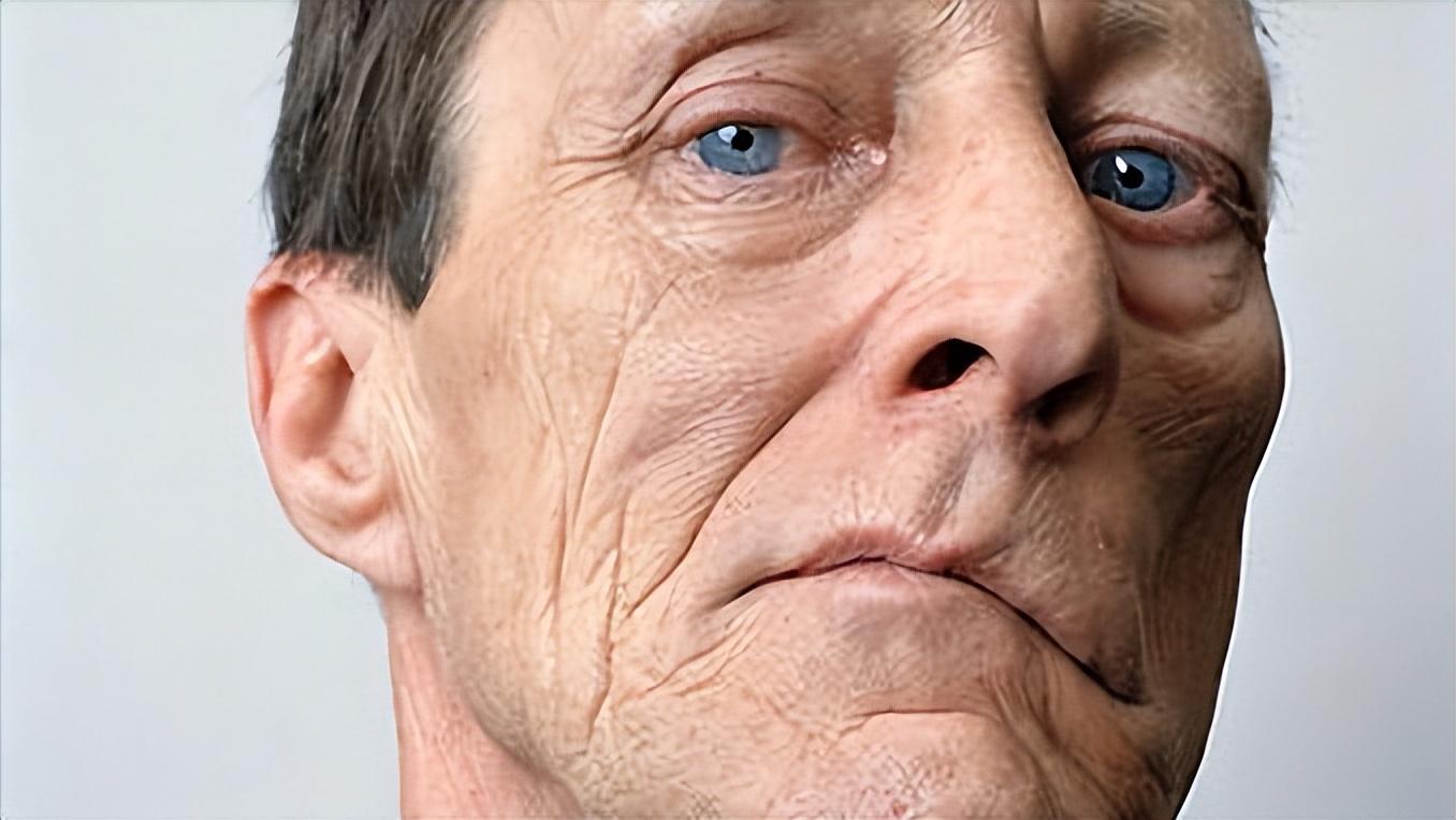 面神经麻痹后遗症的最佳治疗方法,面神经麻痹面部有麻木感觉吗