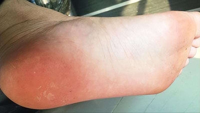 小孩脚底板磨出茧子走路特别疼,脚底板爱进风什么原因