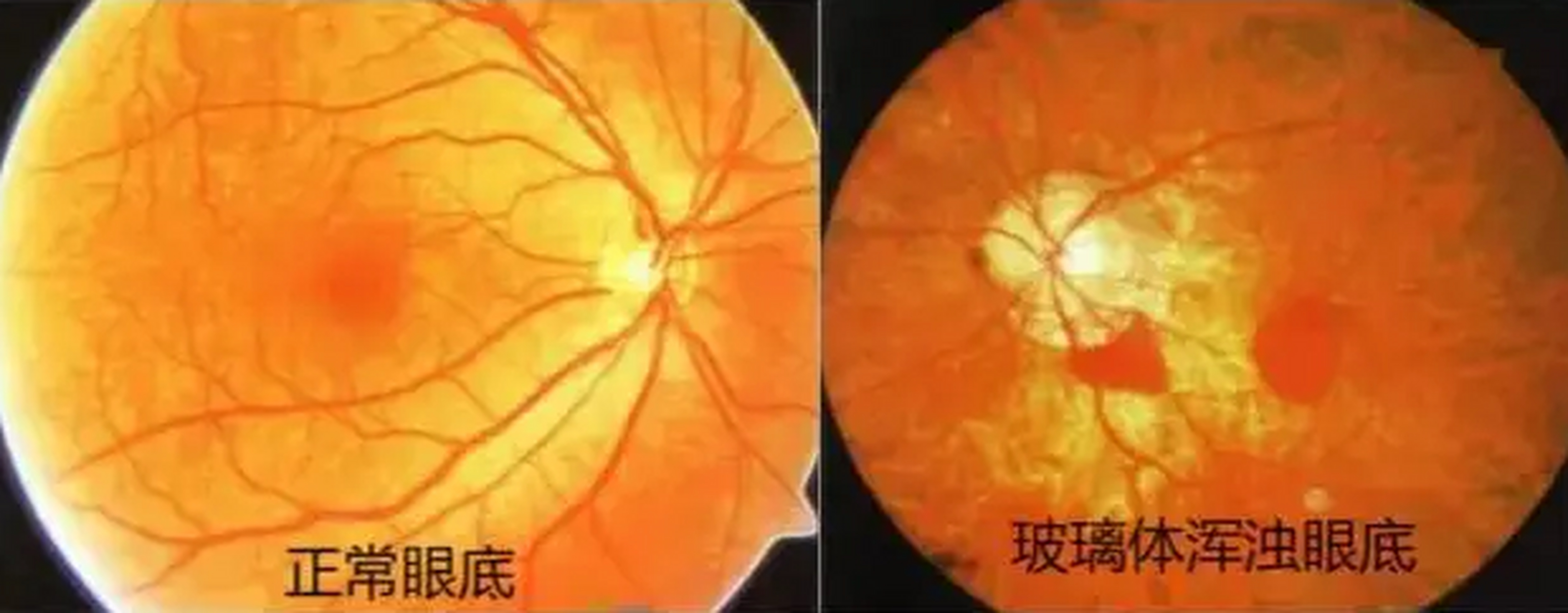 眼睛有蚊影飞来飞去是什么疾病,眼睛突然好像有蚊子在飞什么原因