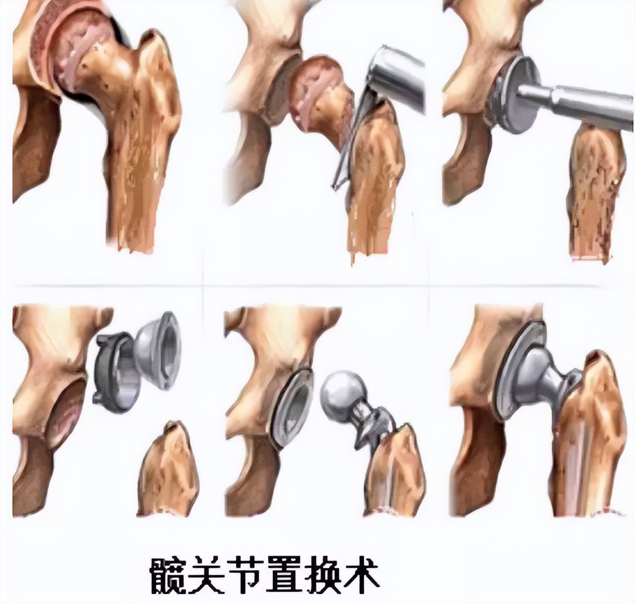 股骨置换后二次摔倒会骨折吗,关节骨折手术最常见的后遗症