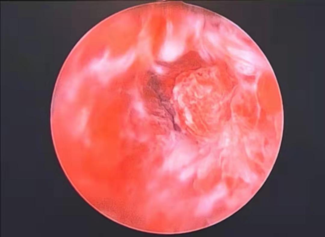 门诊微型宫腔镜诊断技术,市一医院妇科宫腔镜检查